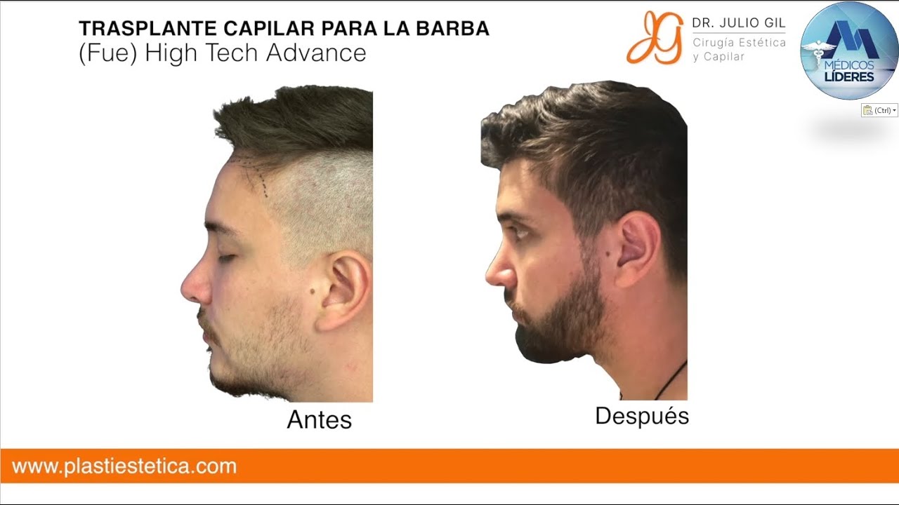 Cirugía de Trasplante Capilar en Barba usando última tecnología (2022)