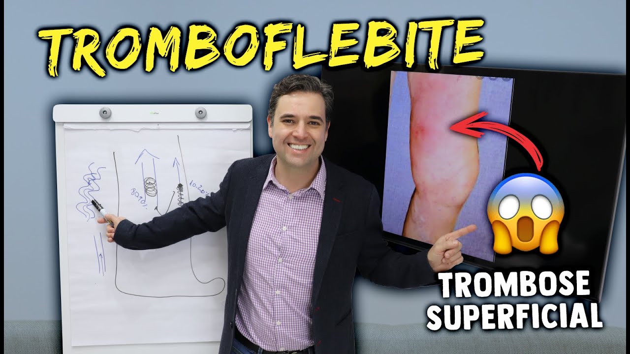 TROMBOFLEBITE | TROMBOSE SUPERFICIAL - Sinais, sintomas e tratamentos!