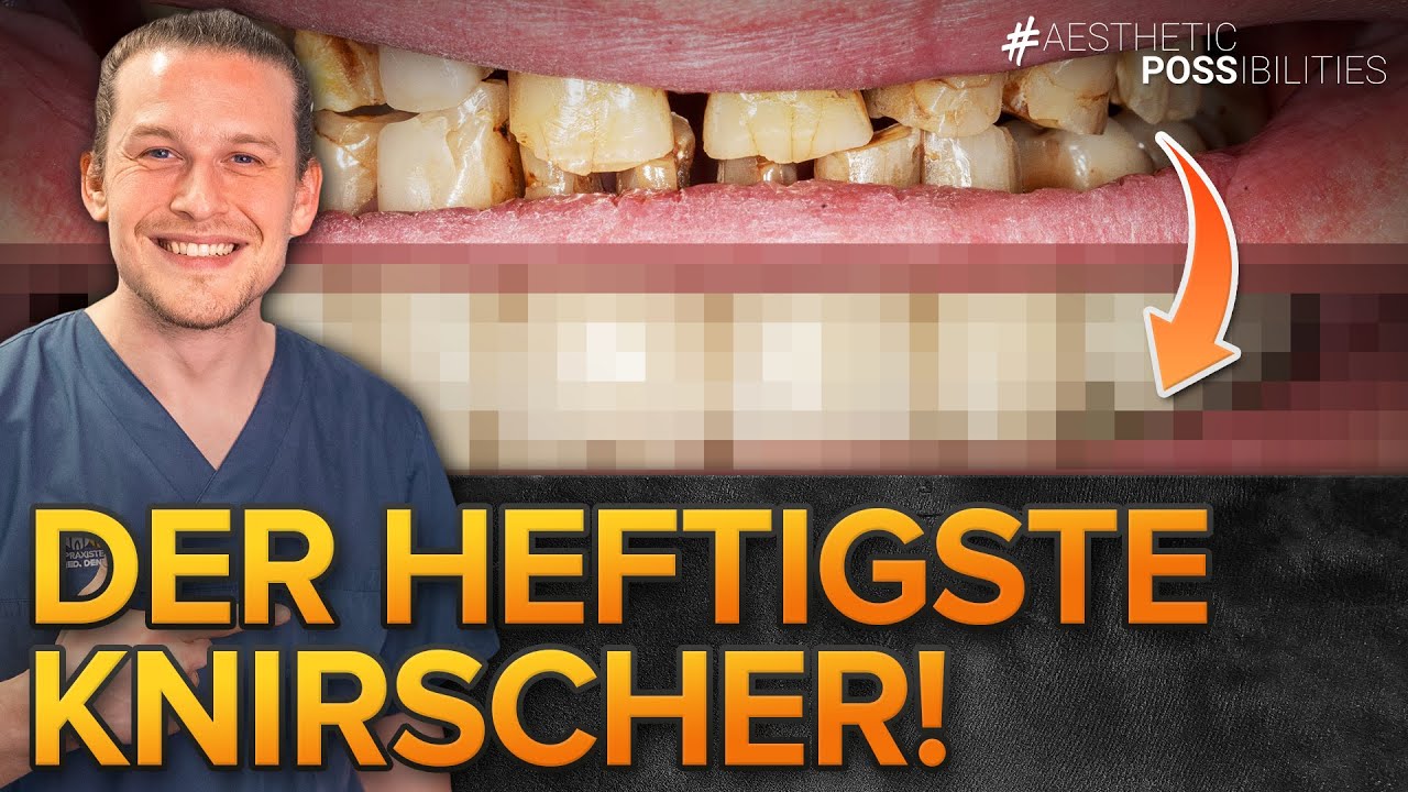Zähneknirschen und defekte Füllungen: Oberkiefer und Unterkiefer mit Kronen und Brücken versorgt
