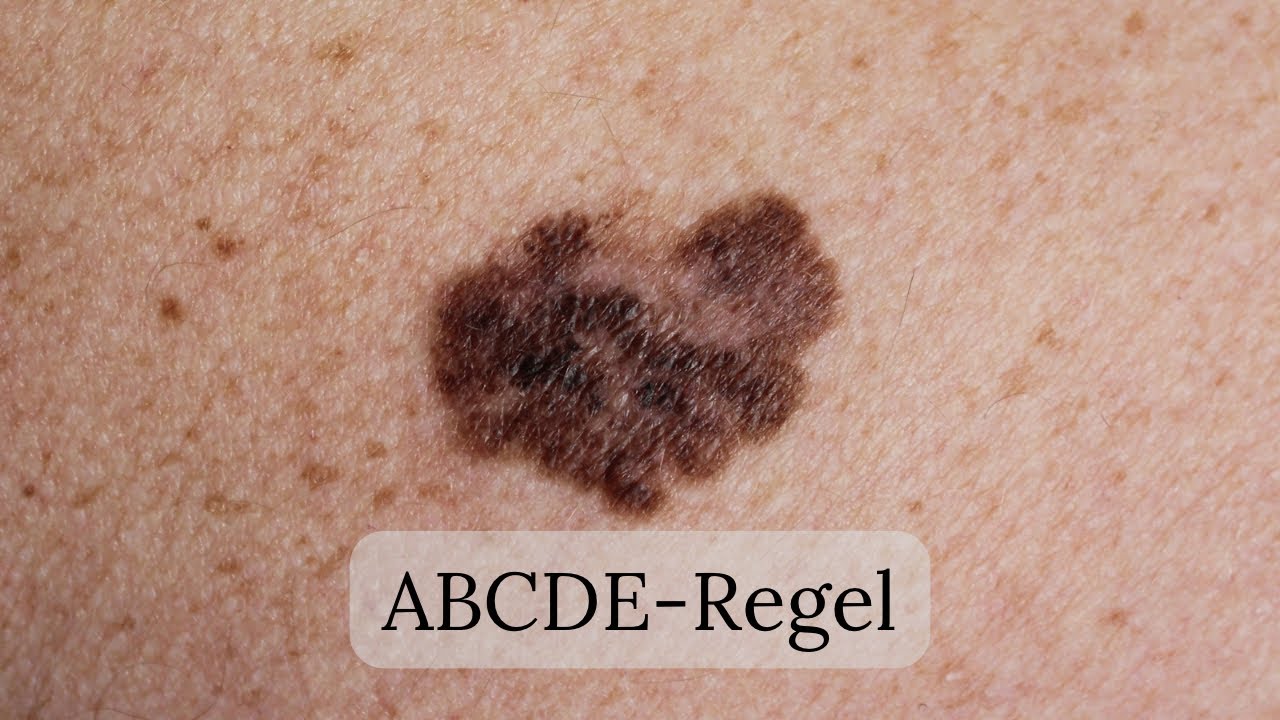 &Auml;rztin erkl&auml;rt: ABCDE-Regel zur Kontrolle von Muttermalen #muttermal #hautkrebs #abcderegel