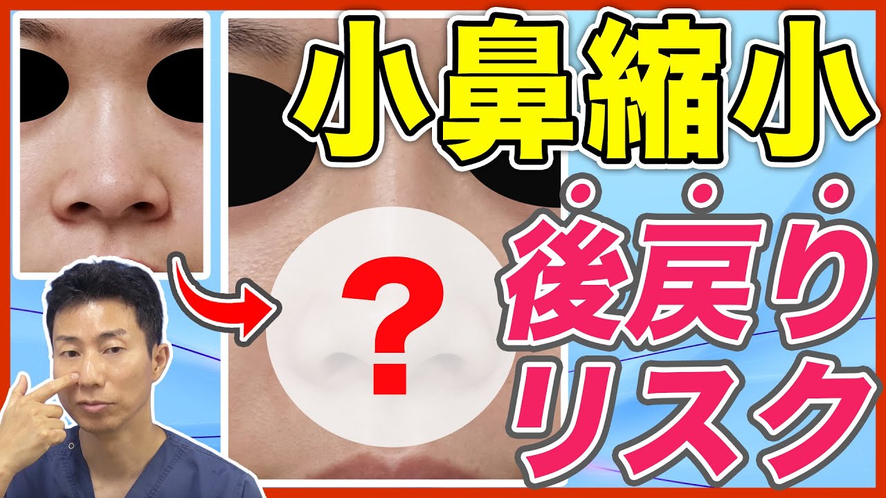 【鼻整形】小鼻縮小の術後の後戻りリスクを防ぐ方法を解説a