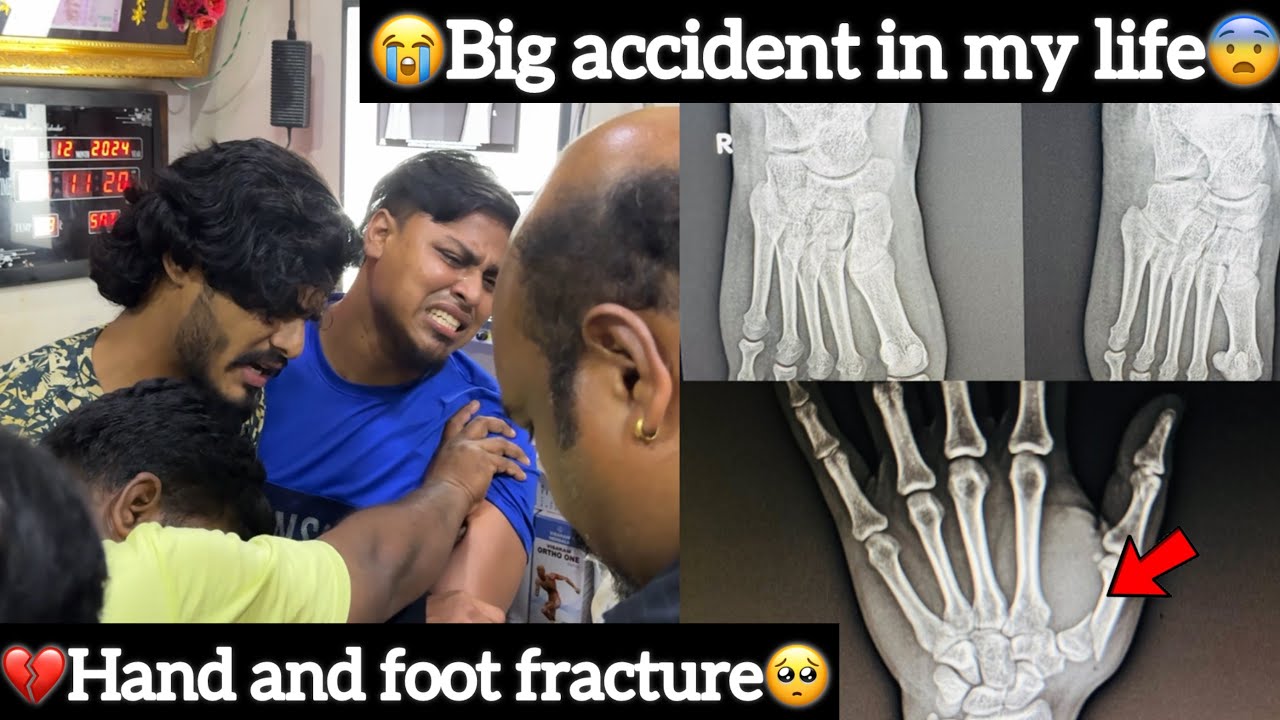 😭Big accident in my life￼🥺|💔Hand and foot fracture😨| Aj Squad | Ajees
