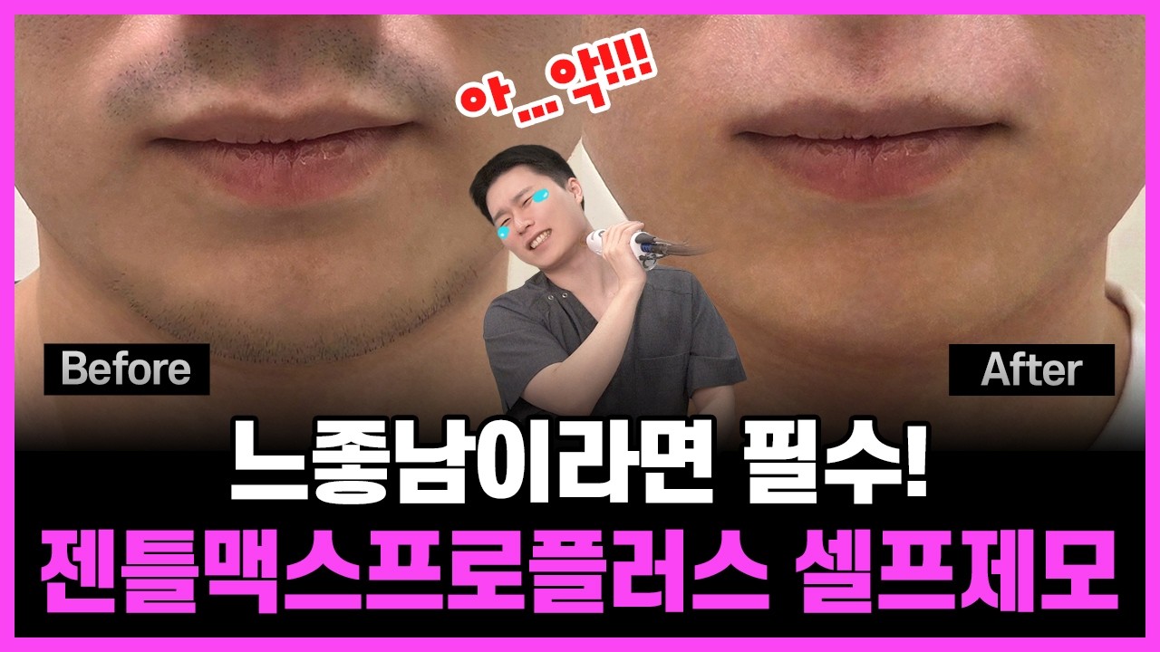 젠틀맥스프로플러스 남성 수염 레이저 제모 후기, 효과,통증, 공개! 느좋남이라면 필수! 의정부레이저제모, 의정부젠틀맥스프로플러스, 의정부피부과, 의정부피부과추천