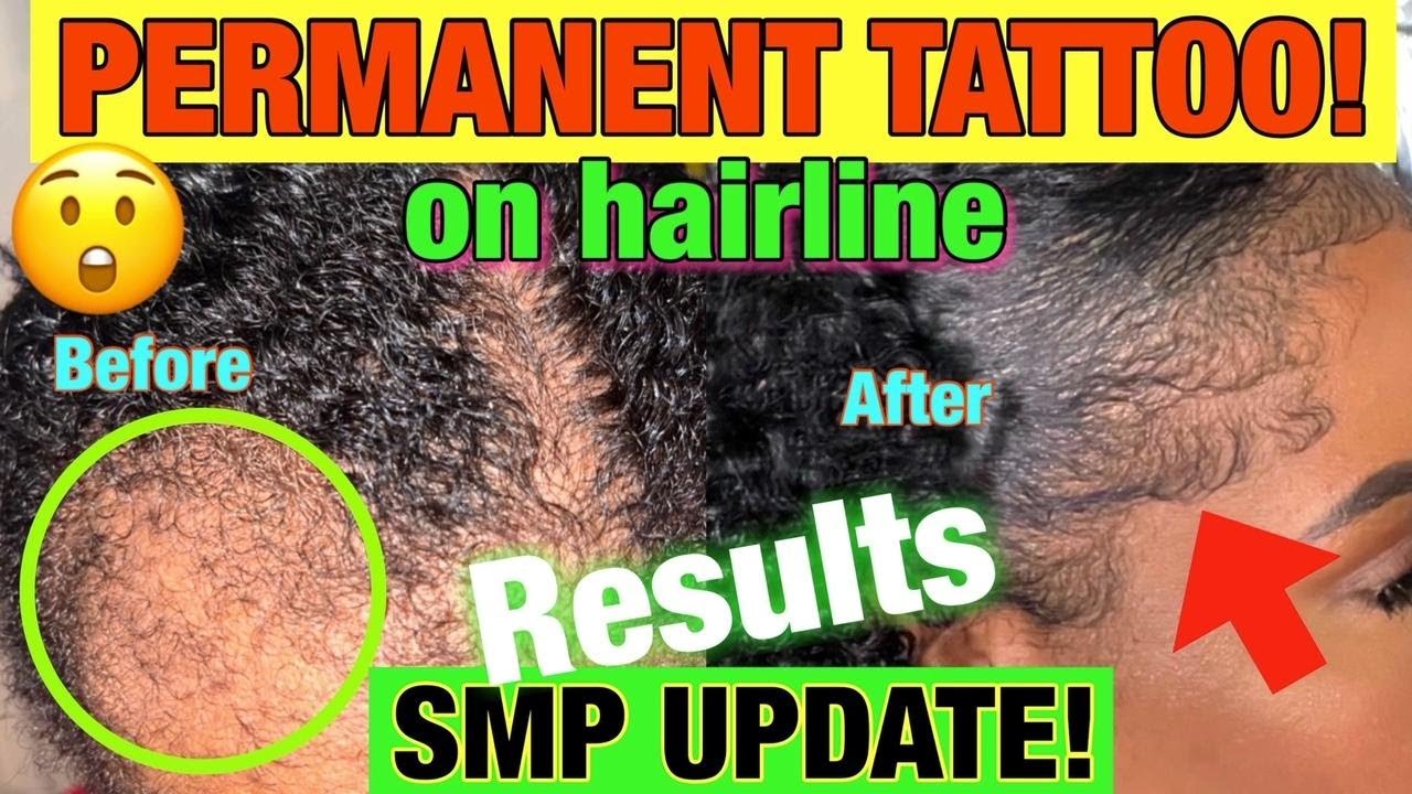 🚨RESULTS from PERMANENTLY TATTOOING my HAIRLINE! SCALP MICROPIGMENTATION SMP Q&A! HAIR LOSS SOLUTION