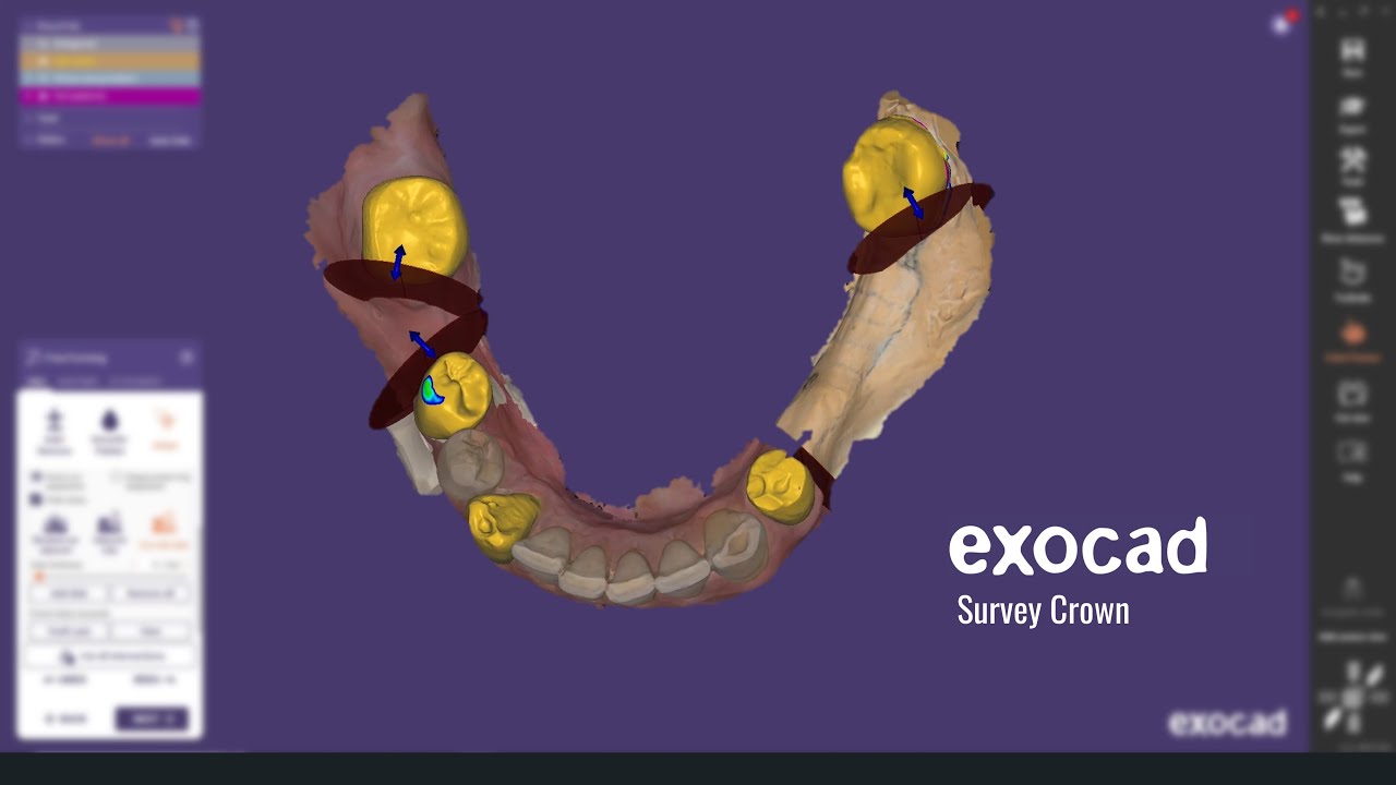 Exocad Survey Crown Case