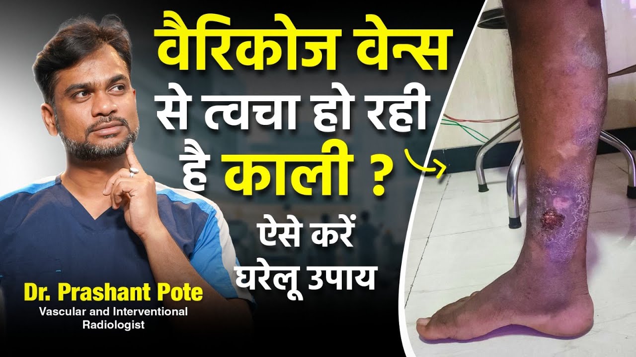 Easy Home Remedies for Skin Discoloration Caused by Varicose Veins | Dr. Prashant Pote