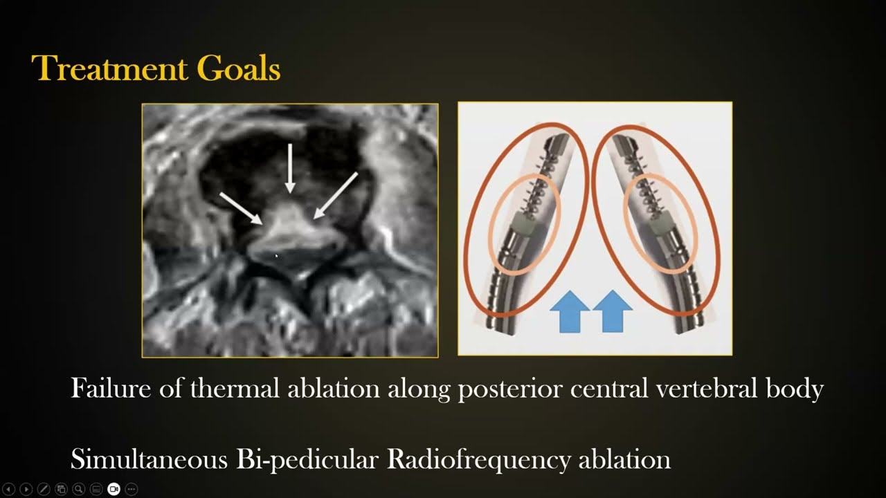 Minimally Invasive Musculoskeletal Interventional Oncology Masterclass - Sample
