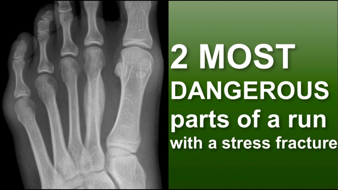 2 most dangerous parts of a run with a stress fracture