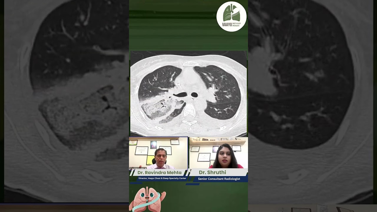 FUNGAL PNEUMONIA