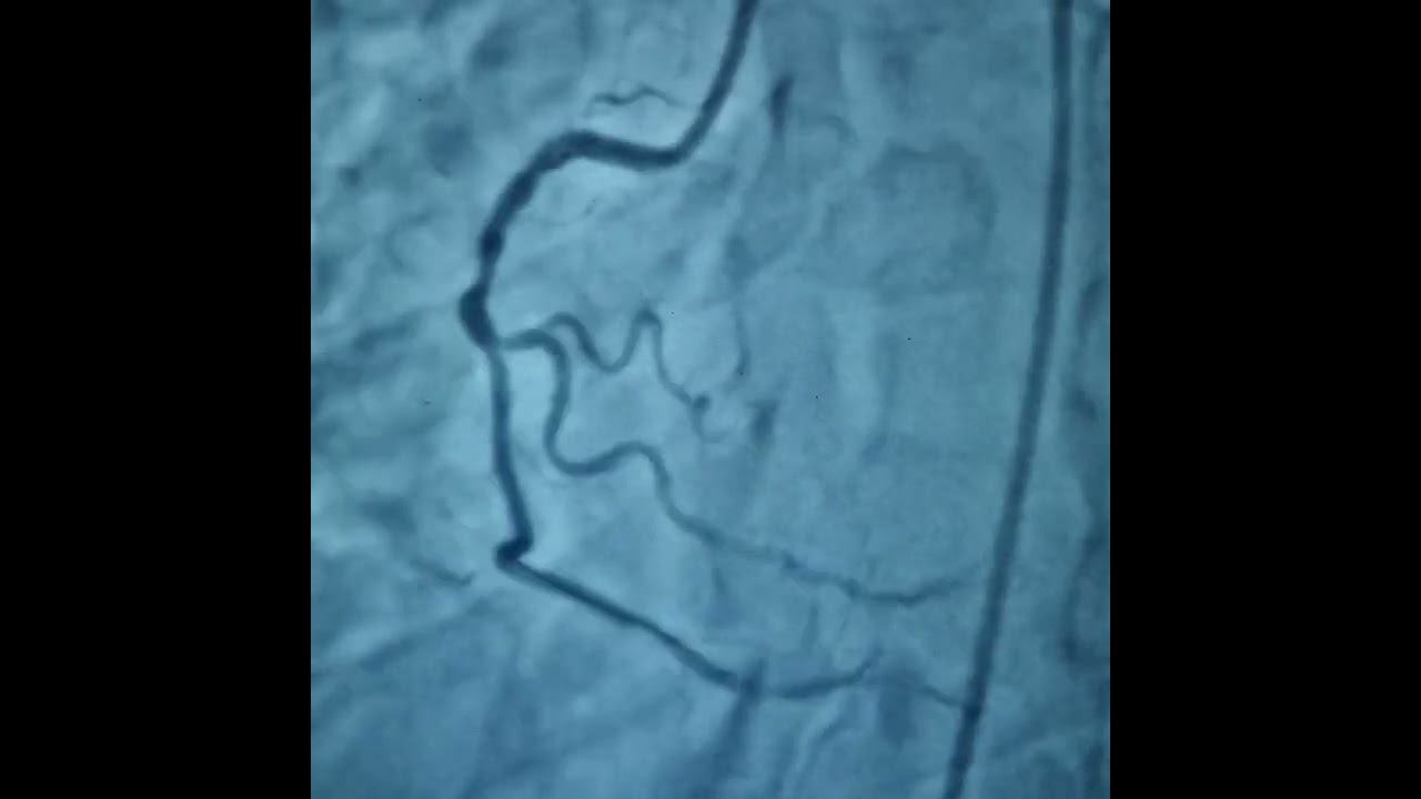 Angioplasty to RCA with 2 stents for Heart Attack| Dr. Rajat Rawat| Best Heart Specialist in Agra