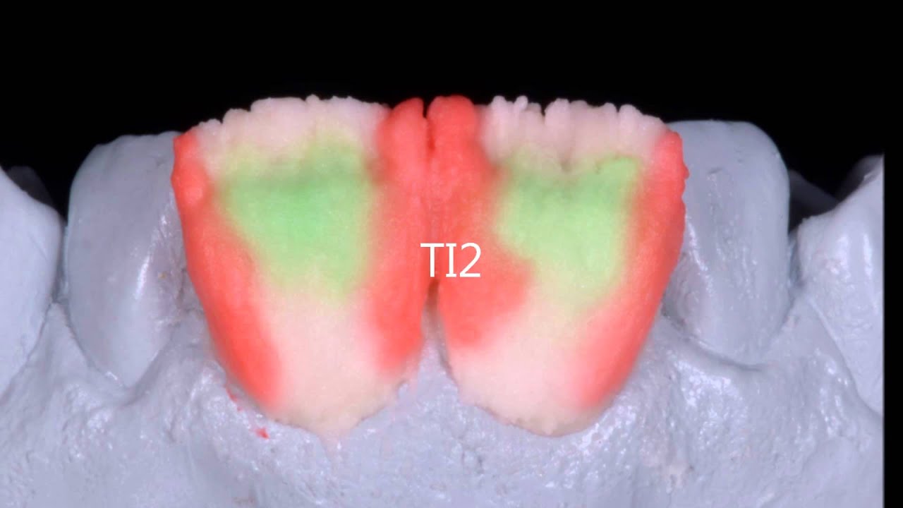 Technique de stratification ZIRPRESS ( Emax Ivoclar)