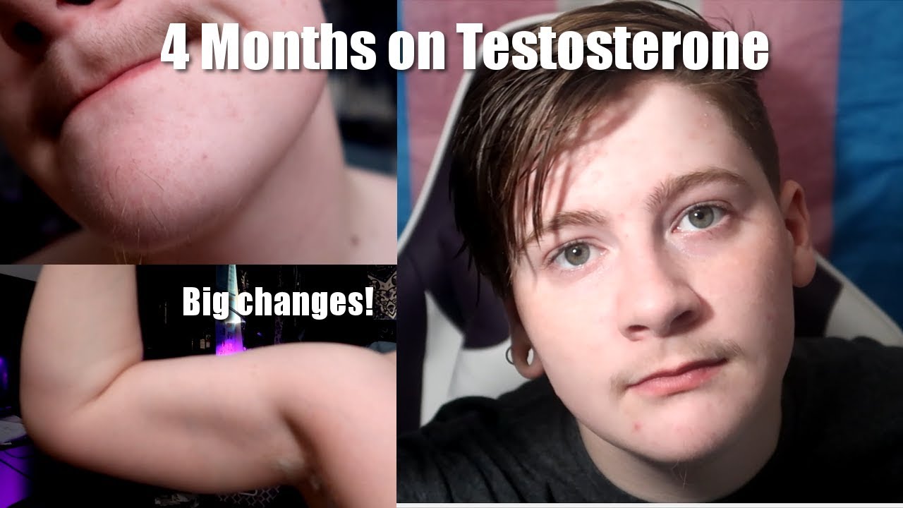 4 Months on Testosterone! Big Body Hair Changes! // FTM