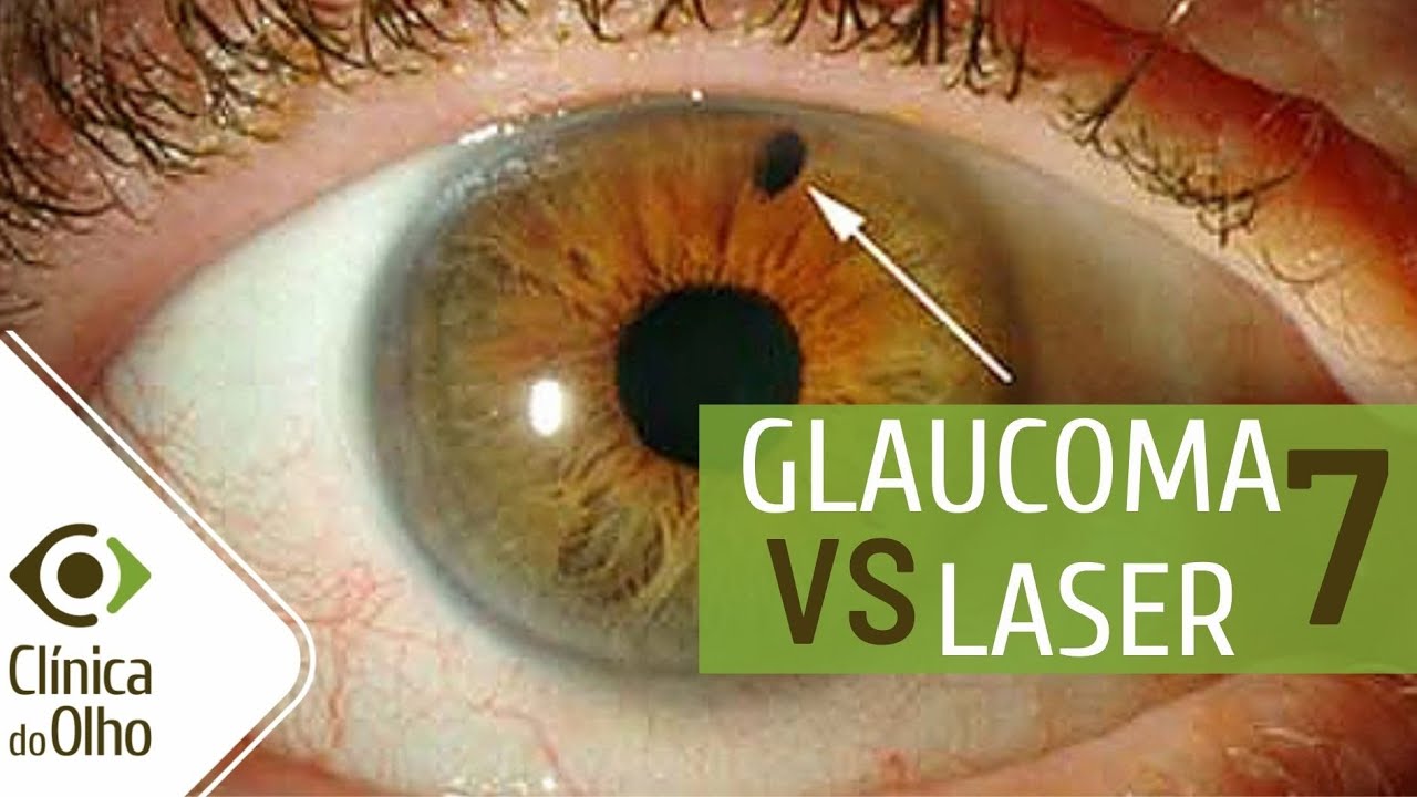 Glaucoma X Laser parte 7 - Como a Iridotomia pode afetar um sintoma do glaucoma