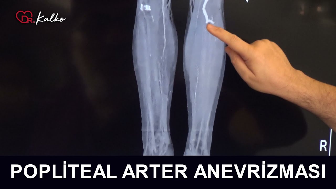 Popliteal Arter Anevrizması (Dizdeki Damarın Baloncuk Haline Gelmesi) | Prof. Dr. Yusuf KALKO