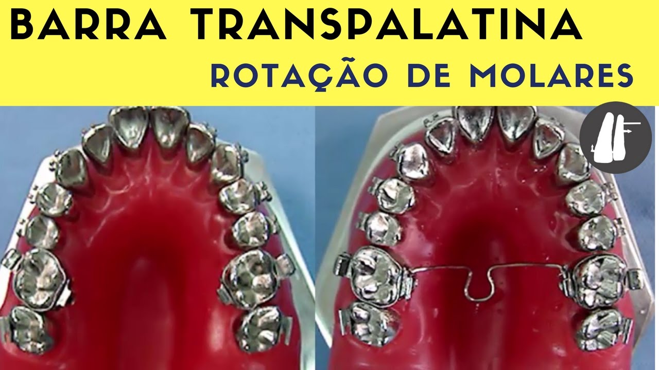 CORREÇÃO DE ROTAÇÃO DE MOLARES