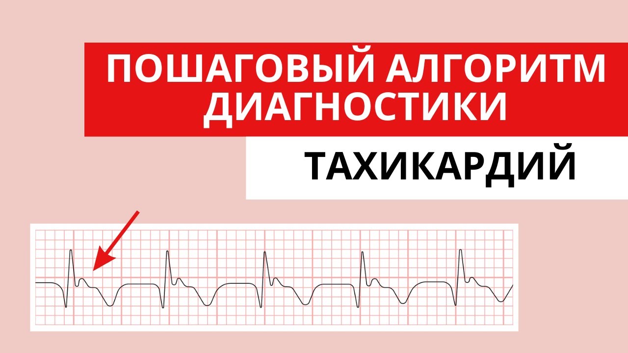 Как отличать тахикардии друг от друга? Алгоритм. Разбор ЭКГ.