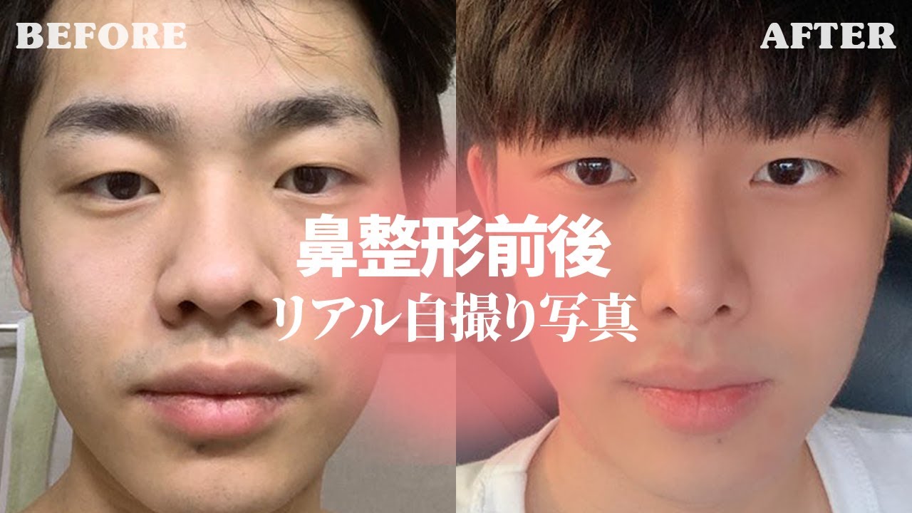 【コノピリアル自撮り写真】 第三弾 ☞ 男性鼻整形（団子鼻+小鼻縮小）