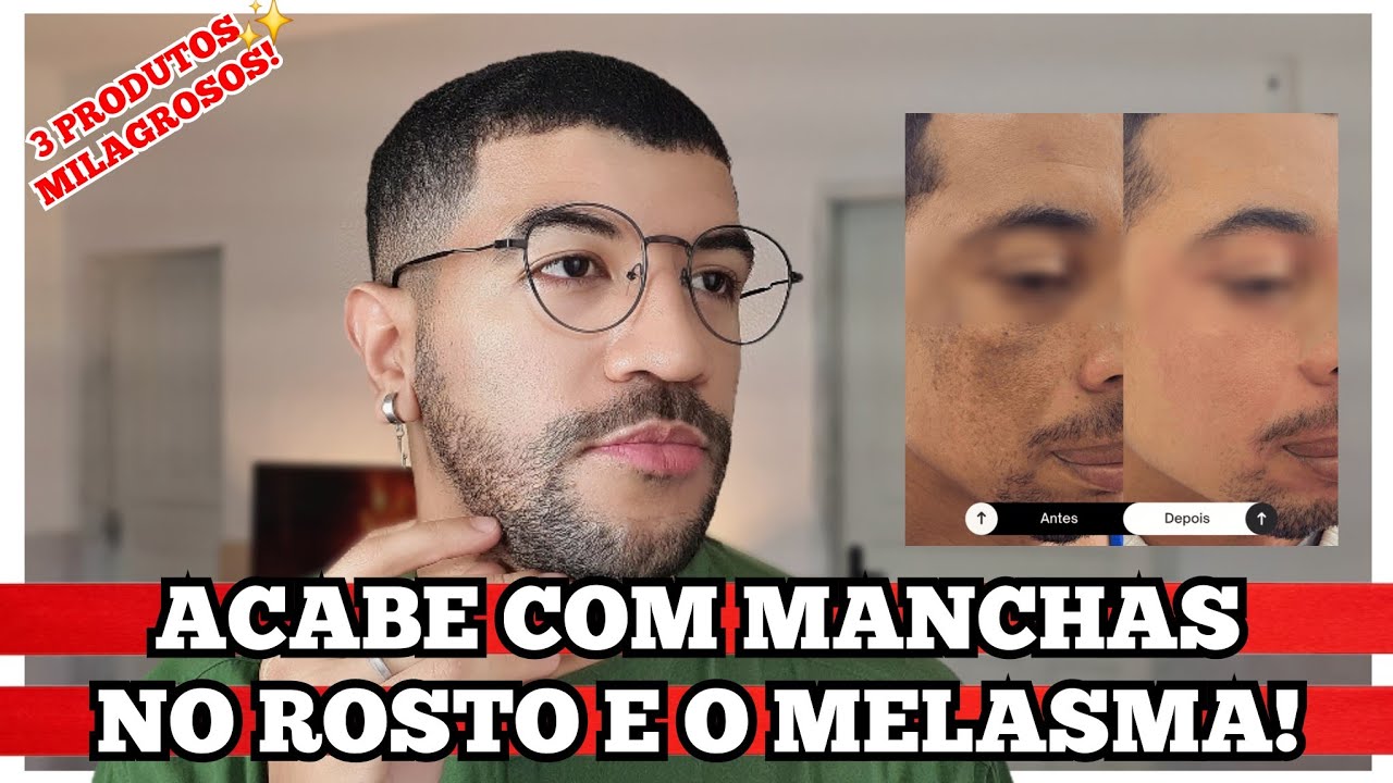 Como Clariei Manchas no Rosto e Melhorei o Melasma Com Apenas 3 Produtos!