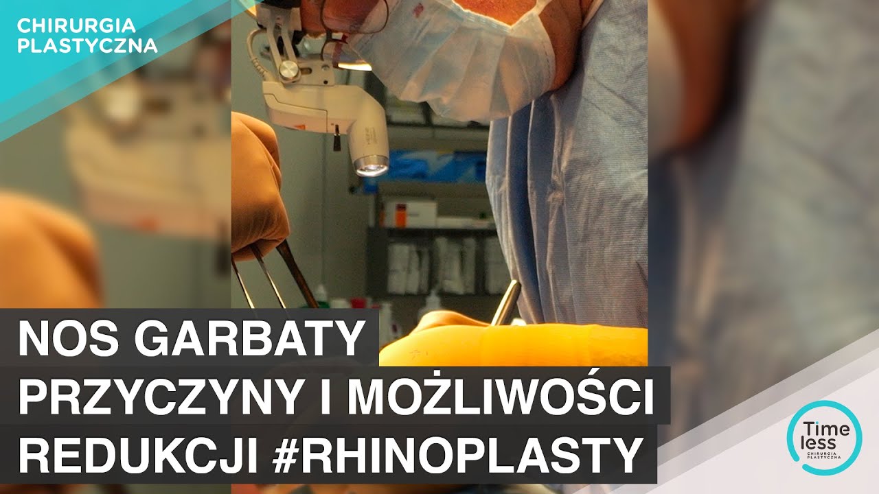 Nos garbaty - przyczyny i możliwości redukcji #rhinoplastyka