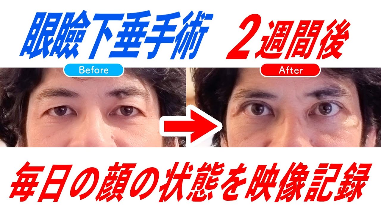 眼瞼下垂手術16日間の記録 BEFORE→AFTER