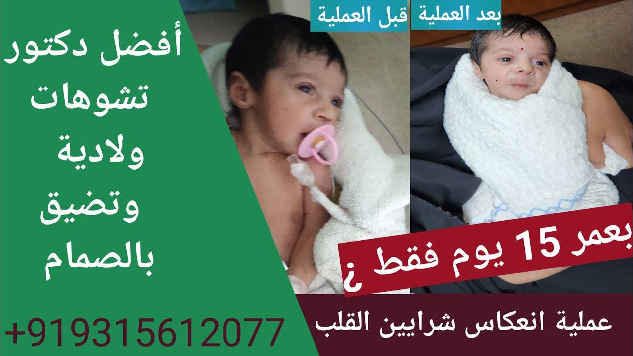 عملية انعكاس شرايين القلبArterialASOl switch operation|تشوهات قلبية ولادية |فتحة بالقلب|تضيق بالصمام
