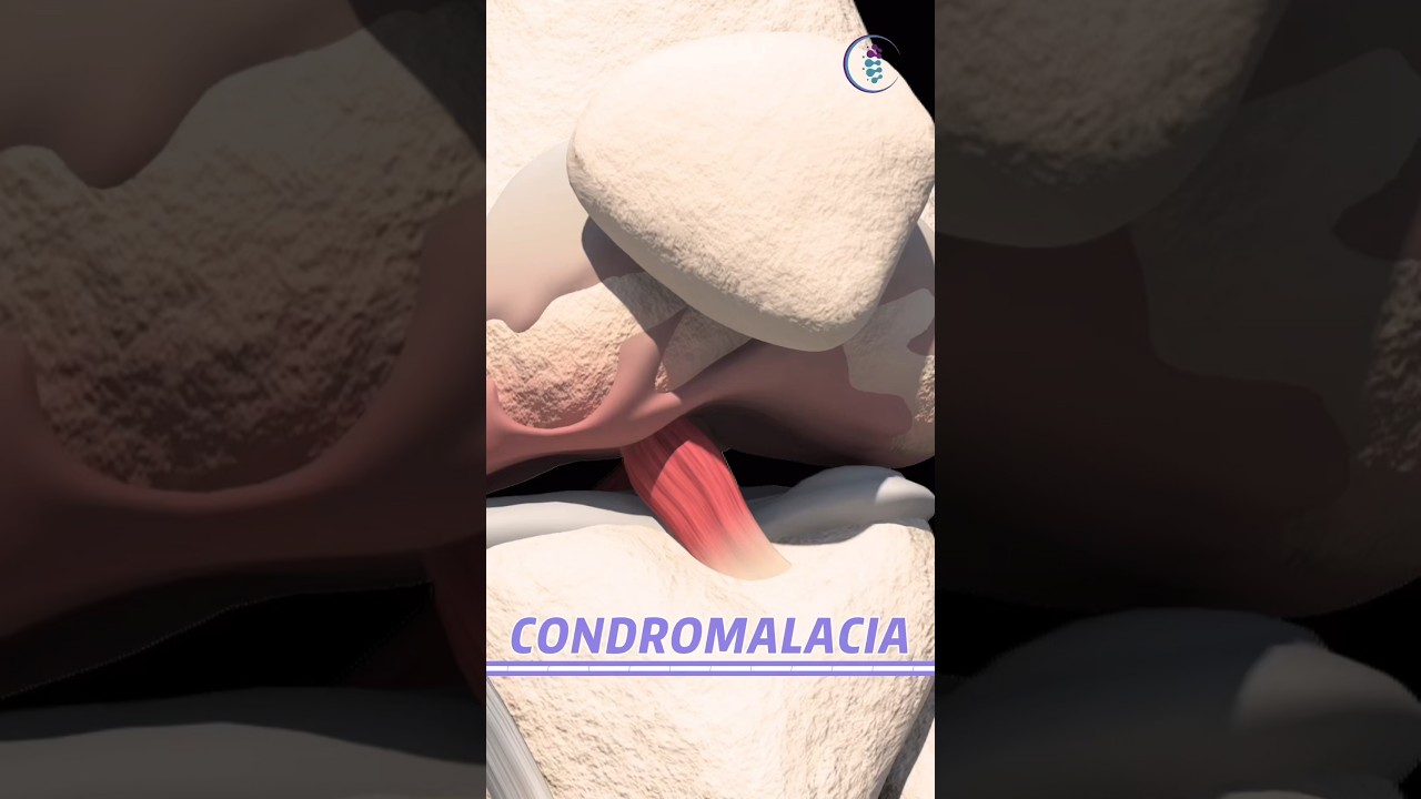 &iquest;Qu&eacute; es la condromalacia? #rodilla #desgaste #lesiones #fisioterapia