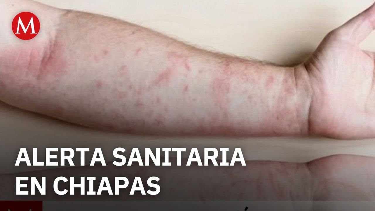 Chiapas emite alerta sanitaria por aumento de casos de sarampi&oacute;n