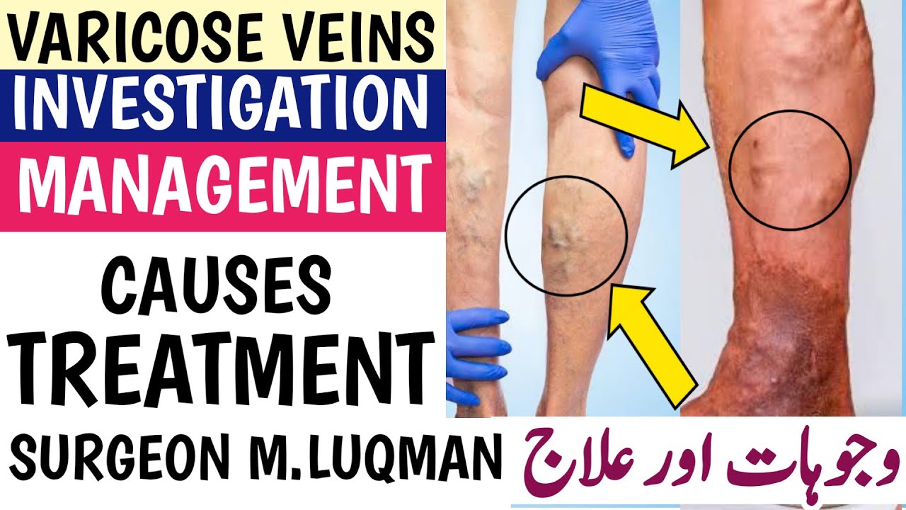 Varicose vein of legs/ رگوں کا پھولنا