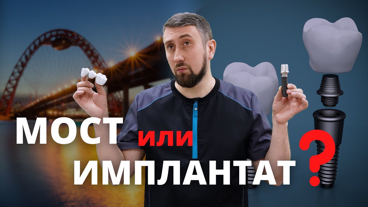 МОСТ или ИМПЛАНТАТ?  Различия. Плюсы и минусы