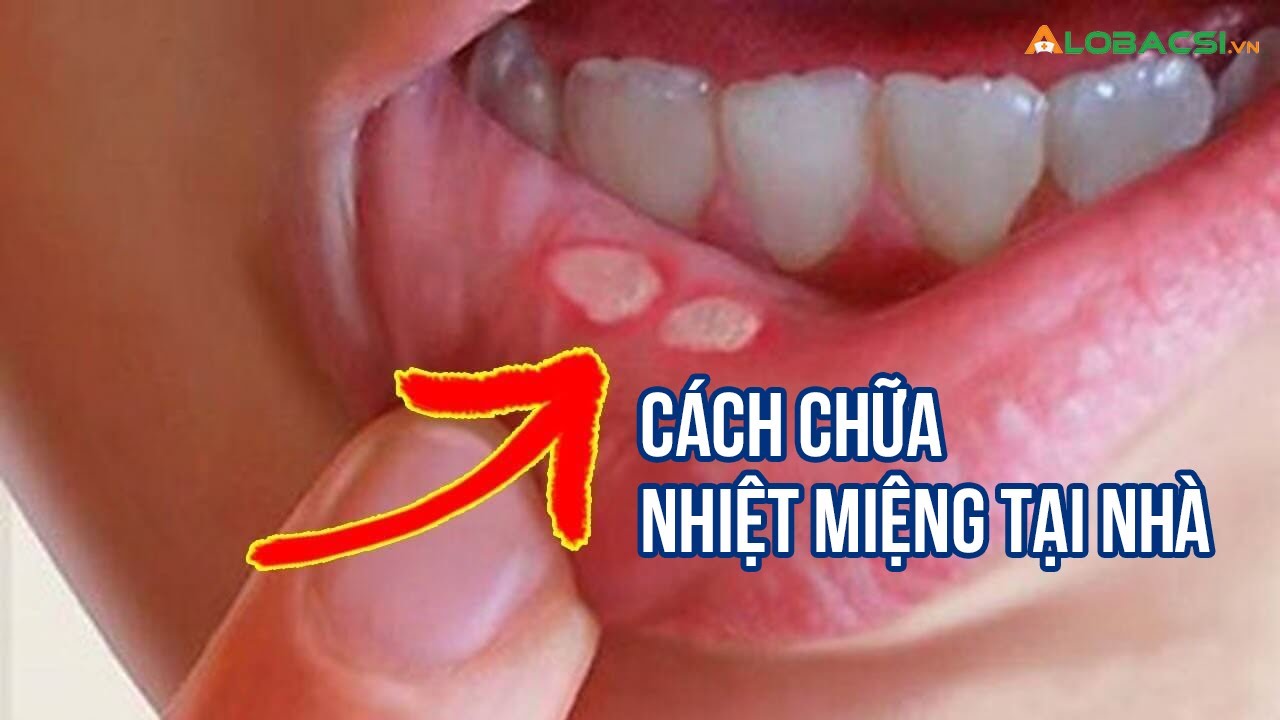 C&aacute;ch chữa nhiệt miệng tại nh&agrave; hiệu quả nhất, nhanh nhất