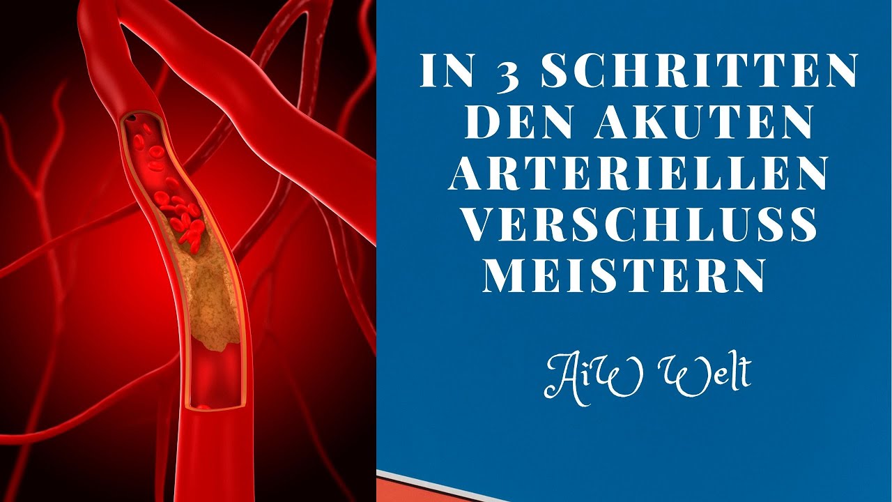 In 3 Schritten den akuten arteriellen Verschluss meistern