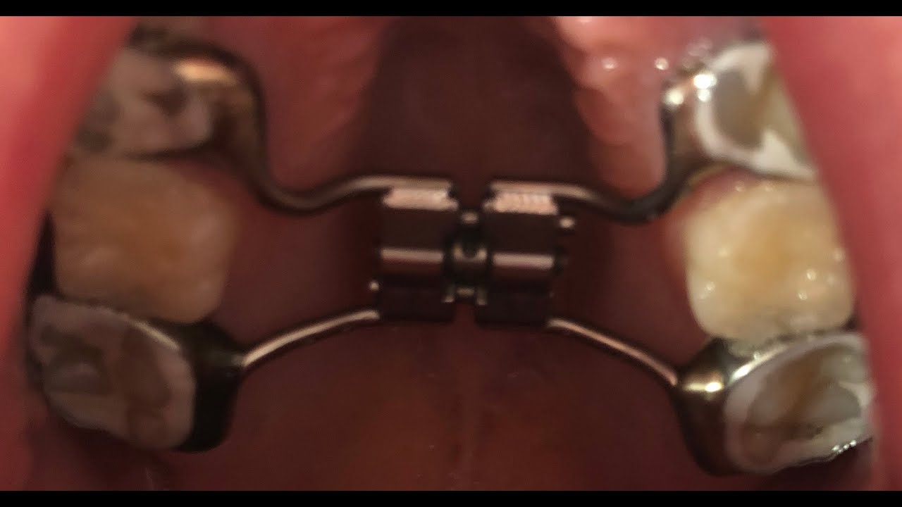 What is a pallet expander?