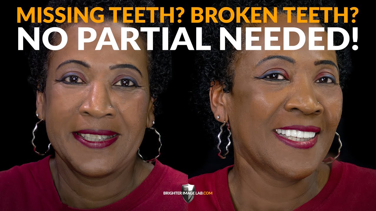 Dental Flippers, Partial Cost Too Much! See This Total Smile Transformation - NODentistVeneer.com