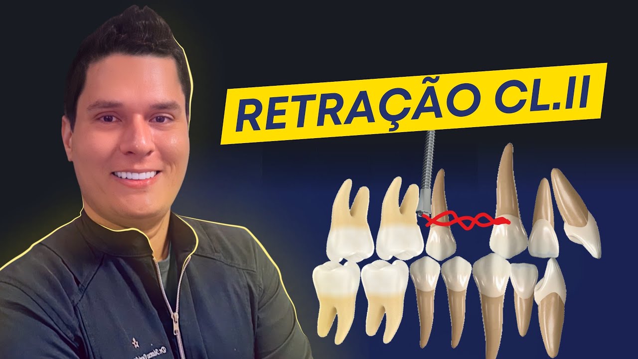 RETRAÇÃO EM CLASSE 2: QUANDO USAR MINI-IMPLANTES?