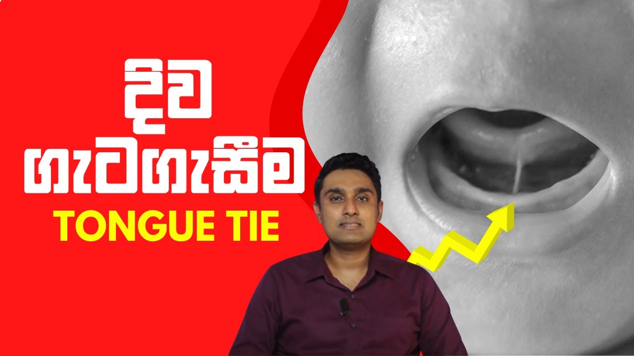 දිව ගැටගැසීම| Tongue Tie | Dishan De Silva | Speech Therapy
