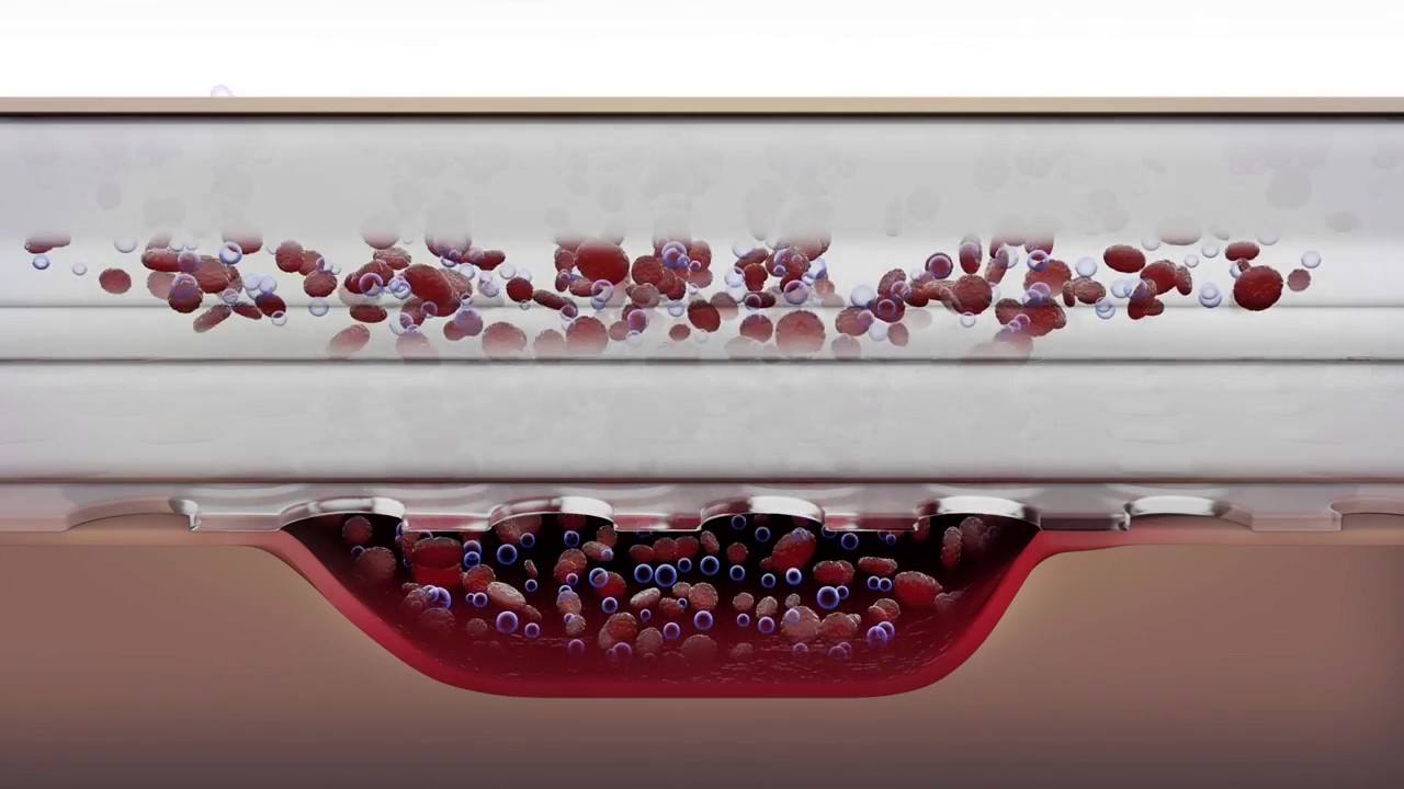 Mepilex Border Self-Adherent Foam Dressing - How it works? | Get flat 10% Off* | Shop Now!