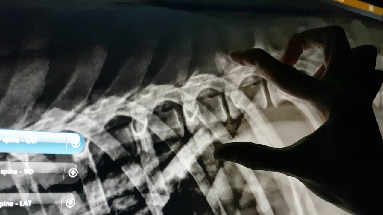 This is a myelogram