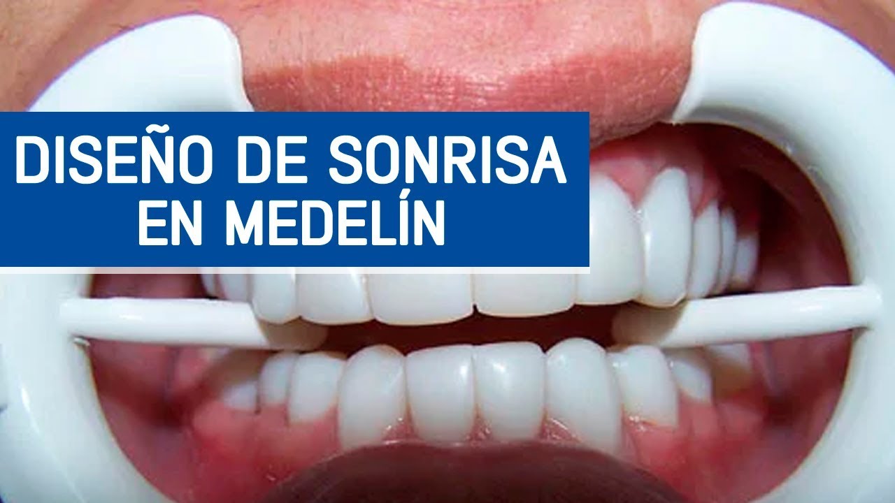 Diseño de sonrisa en Medellín / Odontoespecialistas