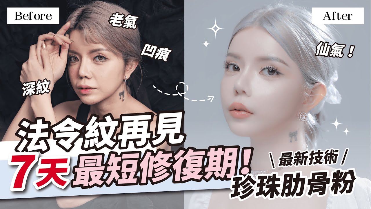 我又整型了！用肋骨墊法令紋😱