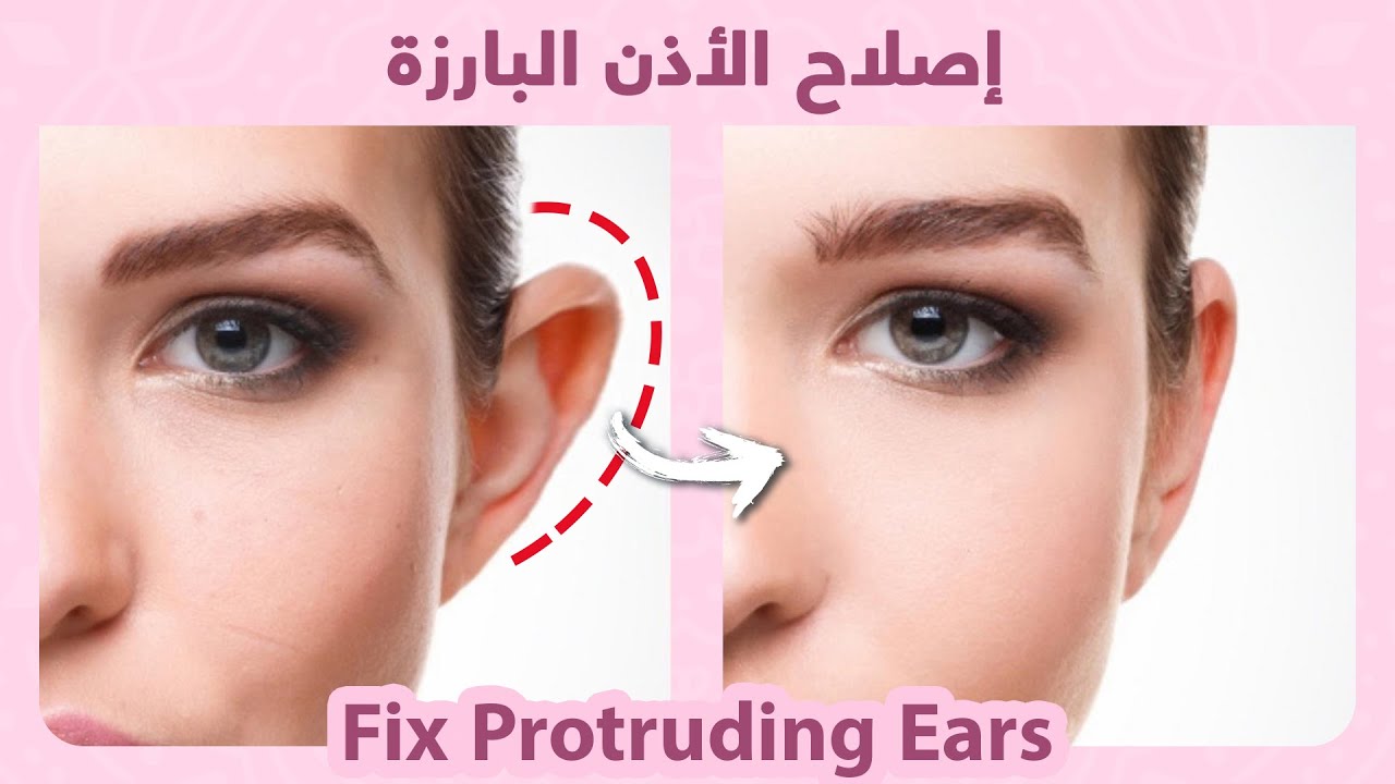 Fix Protruding Ears NATURALLY |  إصلاح الأذن البارزة بشكل طبيعي