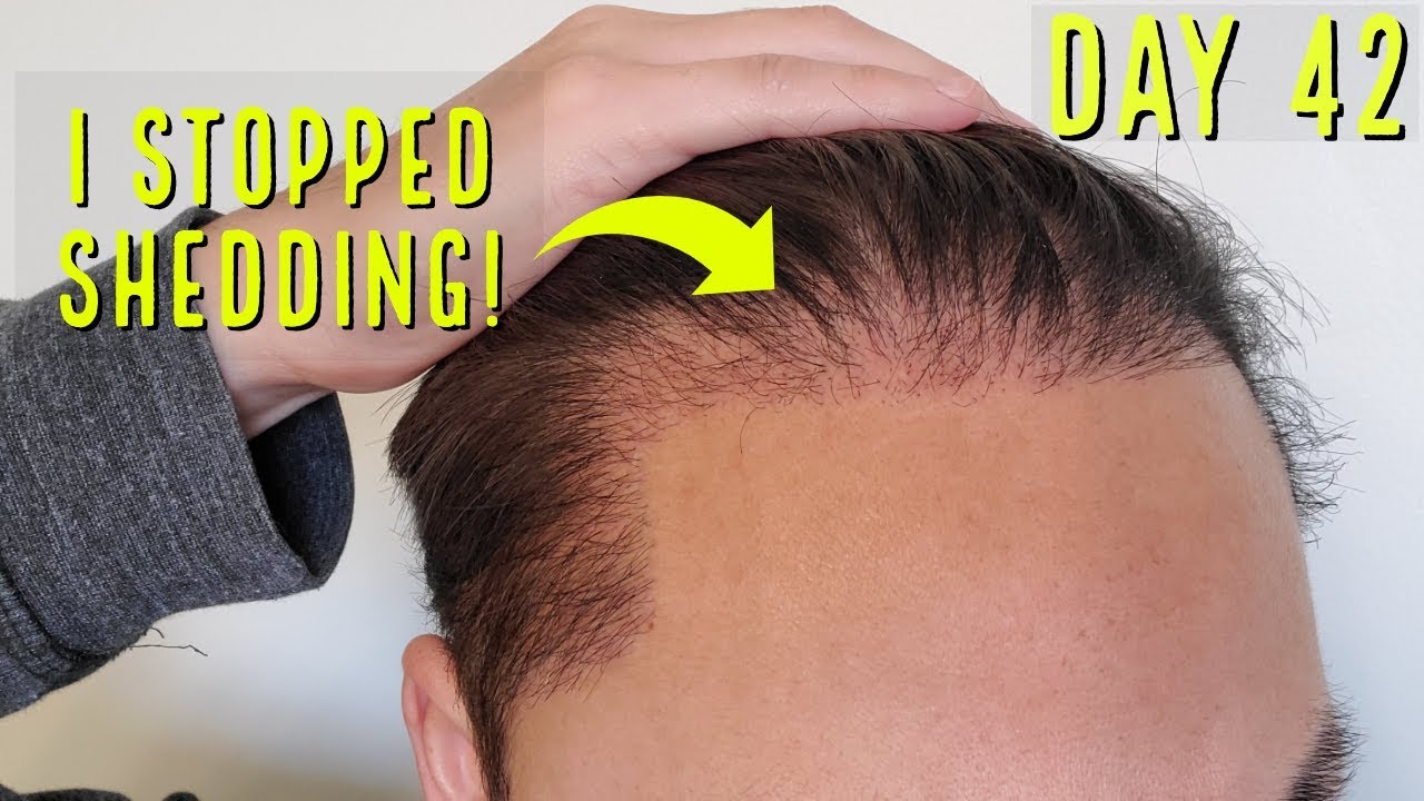 I FINALLY STOPPED SHEDDING AT DAY 42 POST OP 2ND HAIR TRANSPLANT!