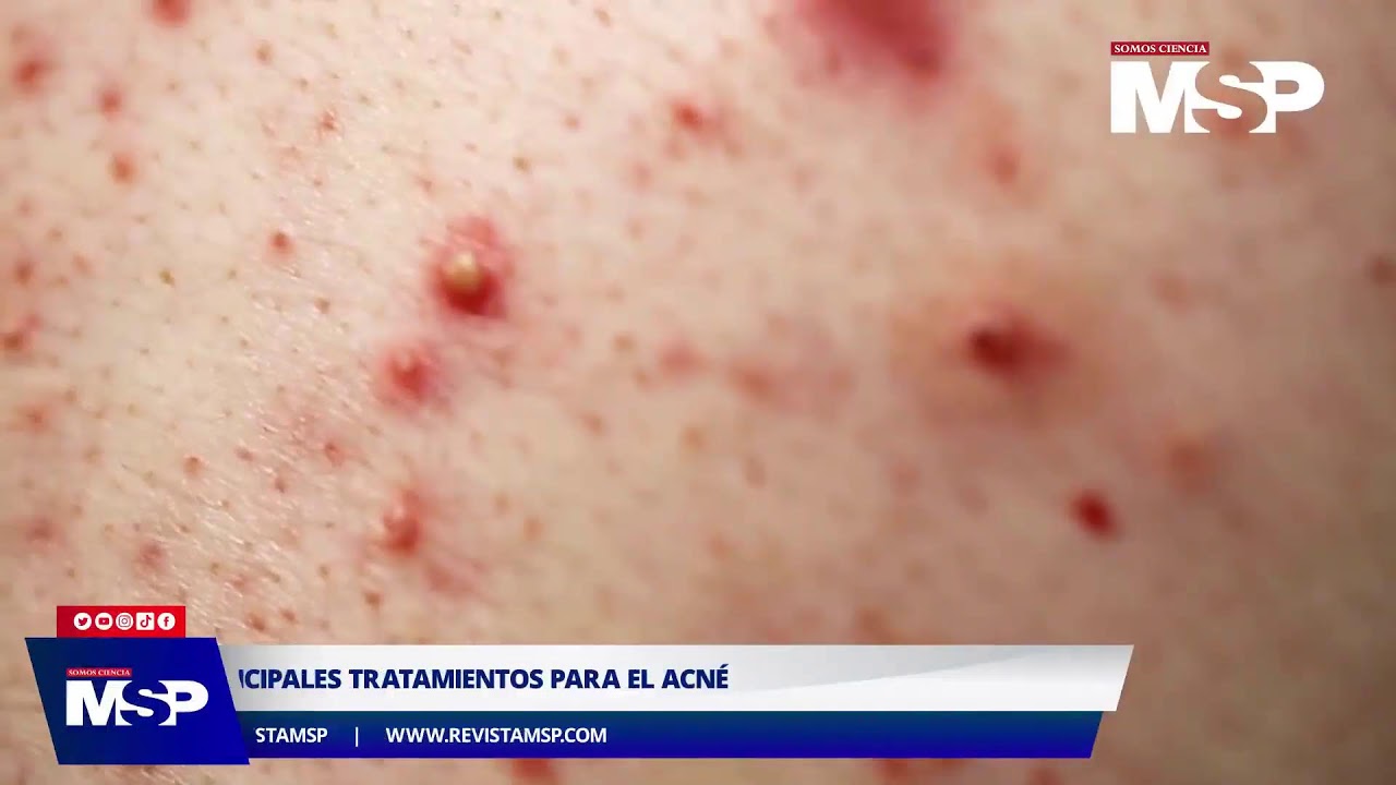 Principales tratamientos disponibles para el acn&eacute; y su manejo - #ExclusivoMSP