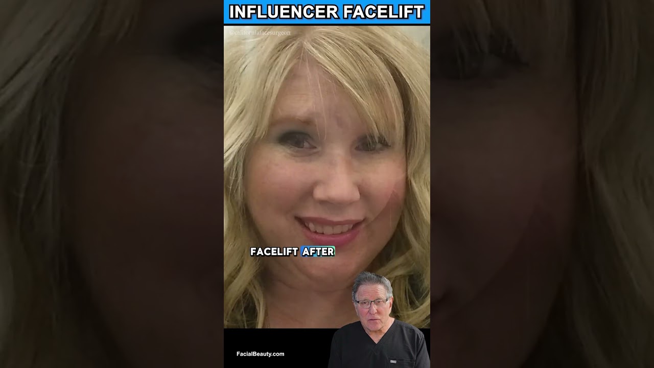 Incredible plastic surgery results with an Instagram influencer. #plasticsurgery #beforeandafter