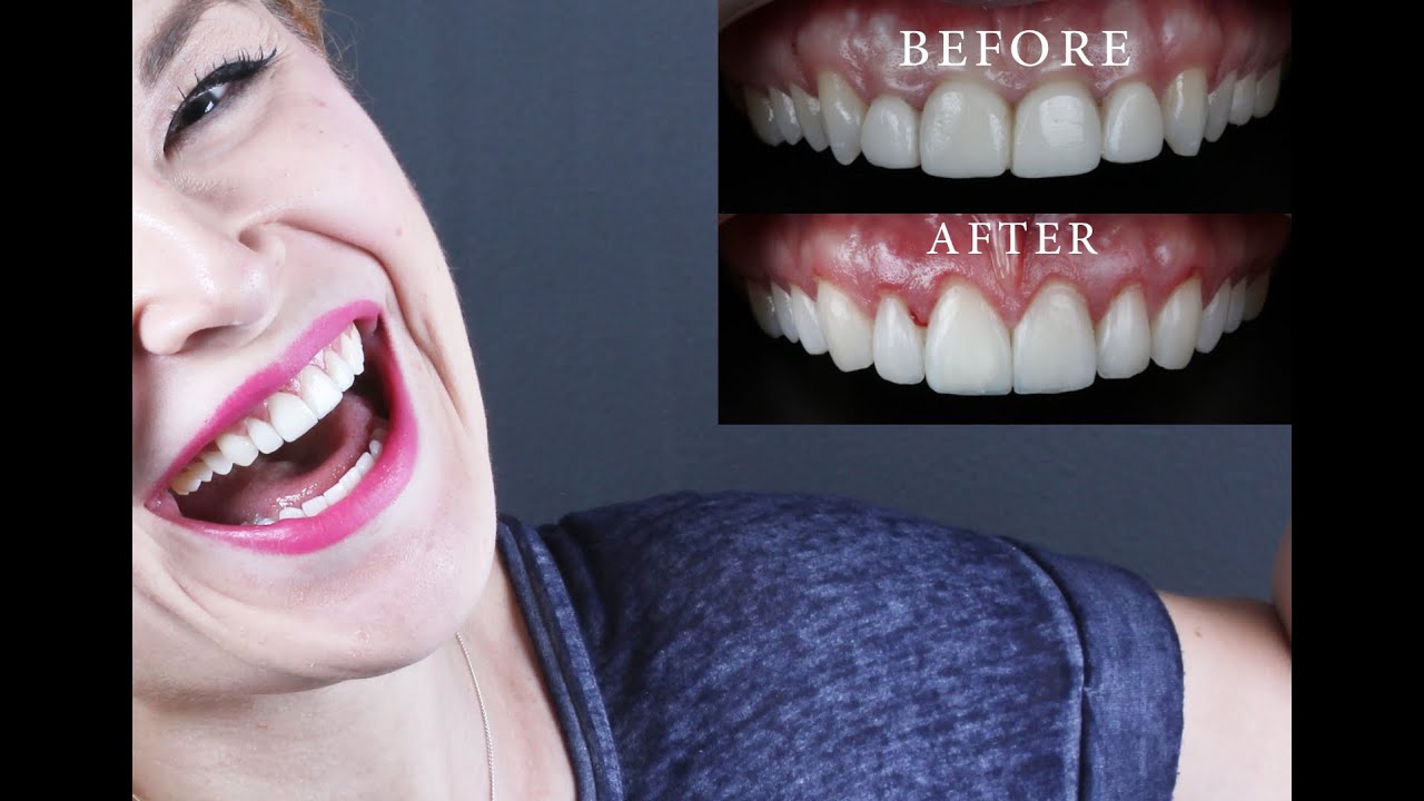 Mi experiencia con las carillas dentales | My experience with veneers