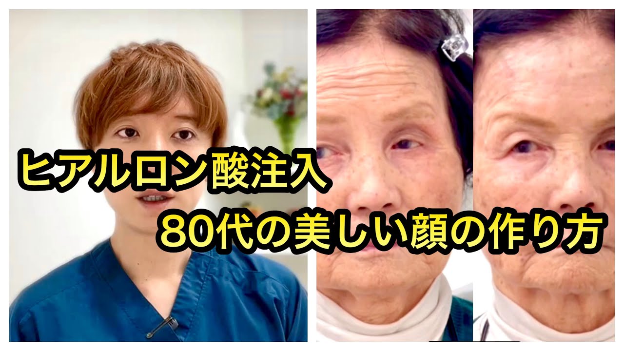 【ヒアルロン酸注入】80代の美しい顔の作り方