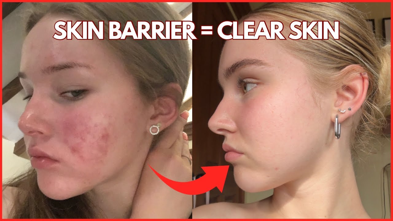 HEALTHY SKIN BARRIER = CLEAR SKIN | how to get one…