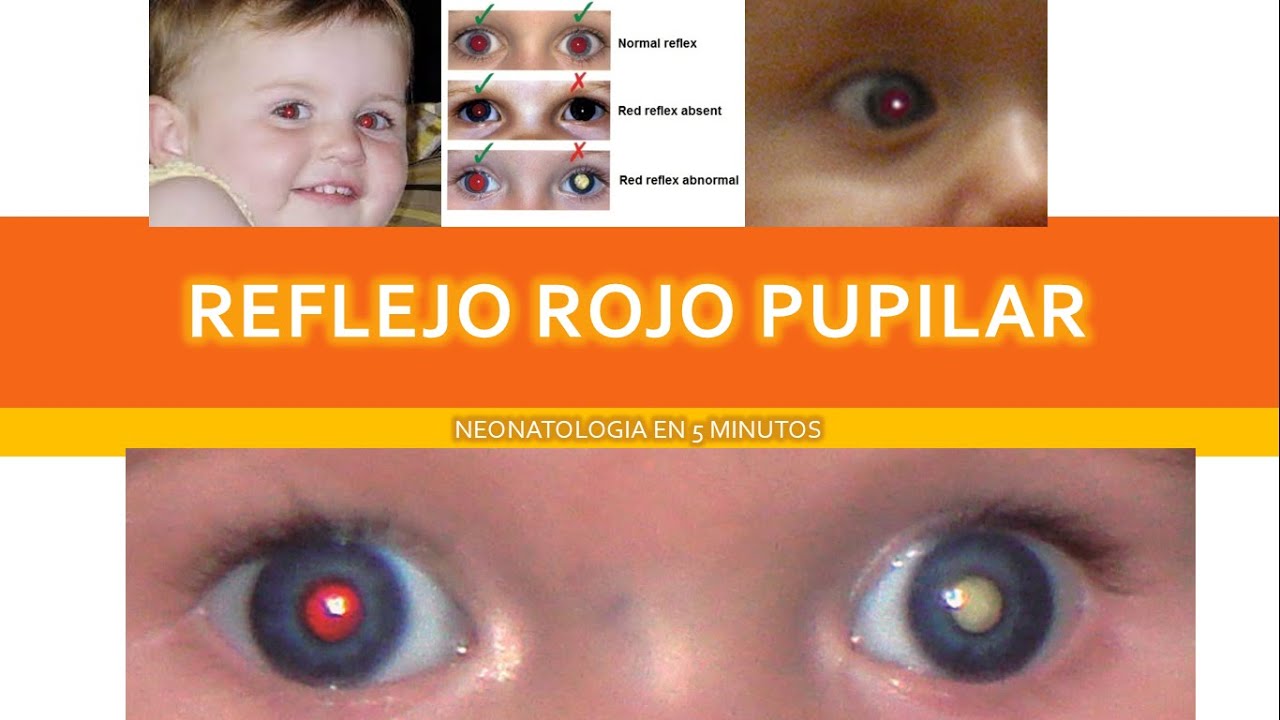 REFLEJO ROJO PUPILAR