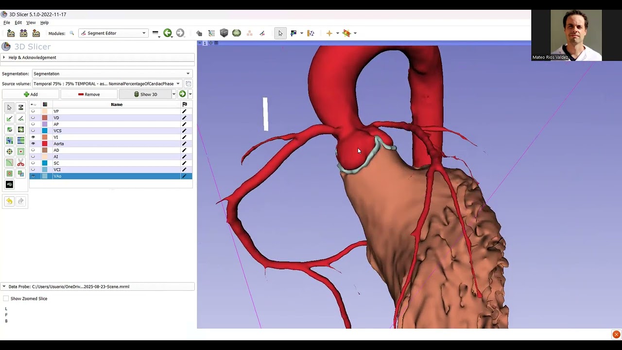 Estenosis supravalvular Ao