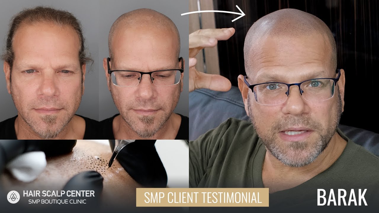 Barak Reviews His Scalp Micropigmentation Experience at Hair Scalp Center in Bangkok, Thailand