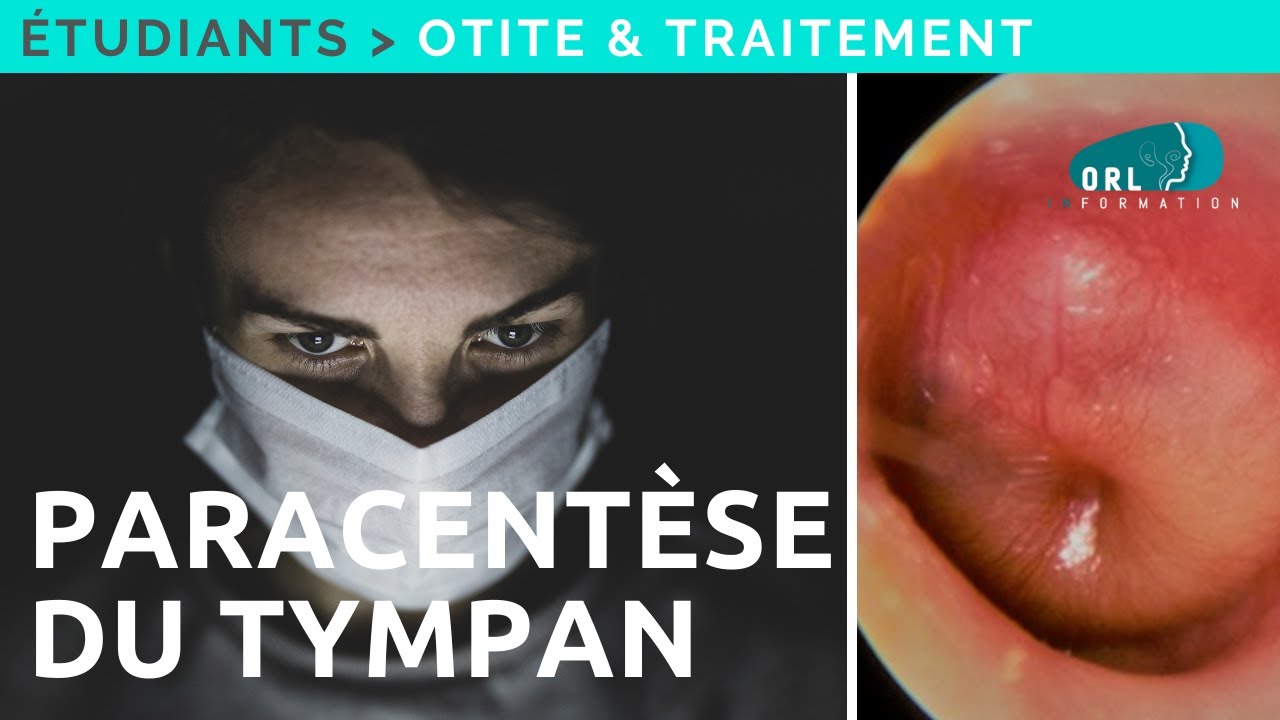 Formation &eacute;tudiant | Paracent&egrave;se du tympan
